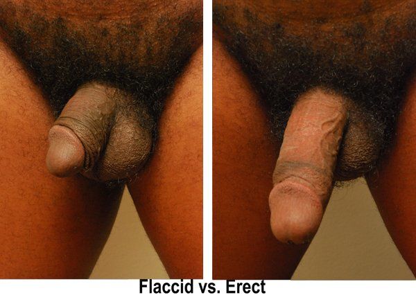 Flaccid erect